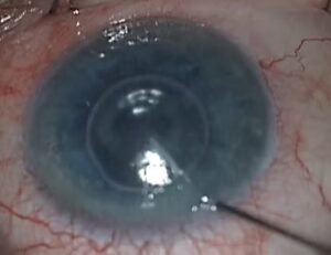 Figure 7- Injection d'une bulle d'air sous le greffon