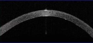 OCT 1 an post Descemthorhexis - Dystroph