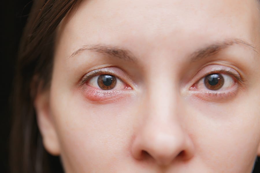 blepharite dr alain saad ophtalmologue paris chirurgien ophtalmo specialiste chirurgie refractive paris blepharite dr alain saad ophtalmologue paris chirurgien ophtalmo specialiste chirurgie refractive paris
