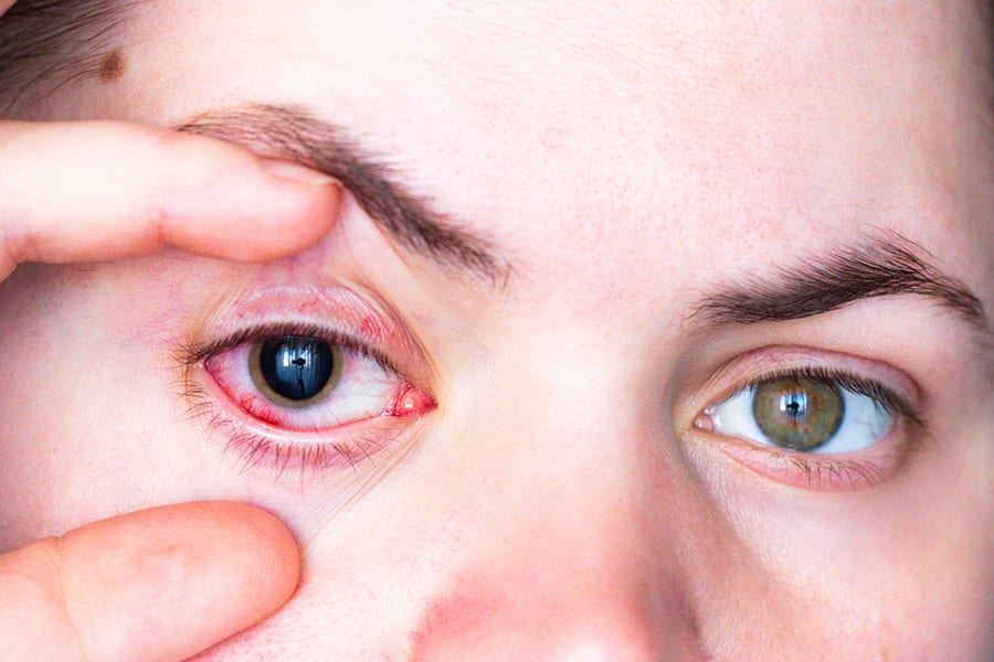 infection corneenne dr alain saad ophtalmologue paris chirurgien ophtalmo specialiste chirurgie refractive paris infection corneenne dr alain saad ophtalmologue paris chirurgien ophtalmo specialiste chirurgie refractive paris