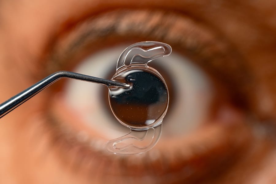lentilles intraoculaires cataracte dr alain saad ophtalmologue paris chirurgien ophtalmo specialiste chirurgie refractive paris lentilles intraoculaires cataracte dr alain saad ophtalmologue paris chirurgien ophtalmo specialiste chirurgie refractive paris