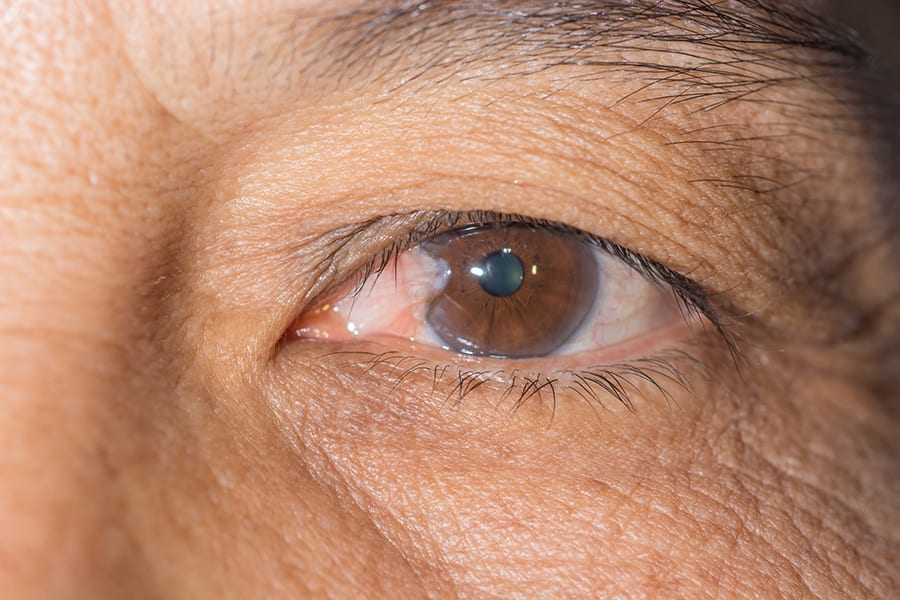 pterygion oeil dr alain saad ophtalmologue paris chirurgien ophtalmo specialiste chirurgie refractive paris pterygion oeil dr alain saad ophtalmologue paris chirurgien ophtalmo specialiste chirurgie refractive paris