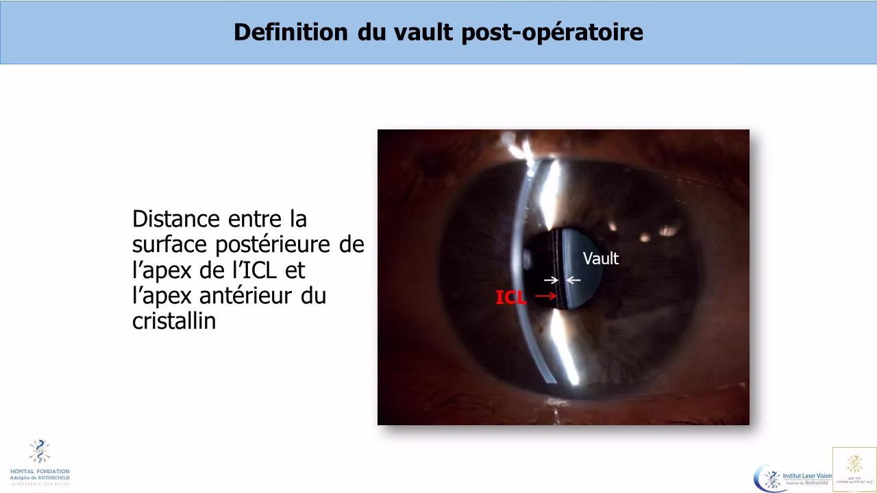 Vault post ICL Vault post ICL